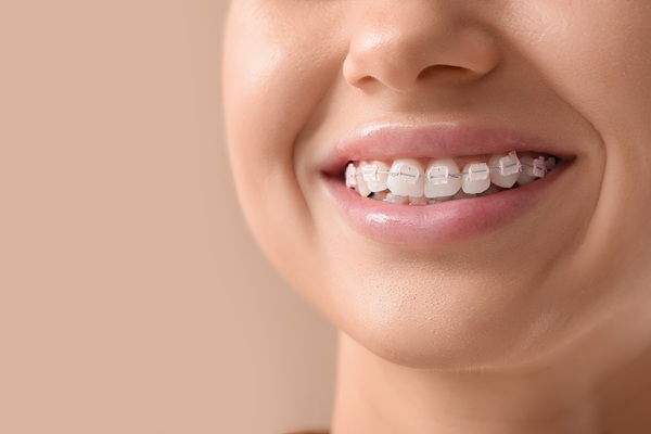 How To Clean Your Teeth When Wearing Clear Braces