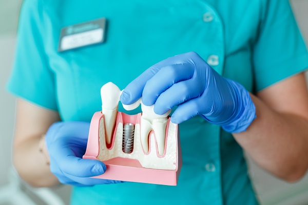 Cosmetic Dentistry: Benefits Of Dental Implants